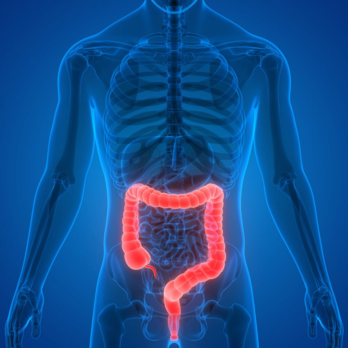 Colorectal Cancer graphic